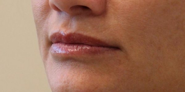 Juvederm Vollure Lips Side - Before