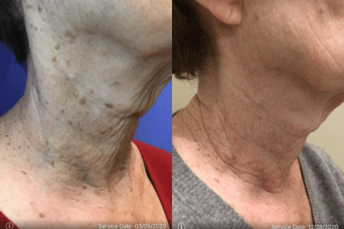 female before and after subnovii plasma pen after one treatment