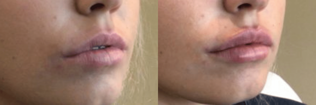 female patient RHA collection lip filler before and after side view