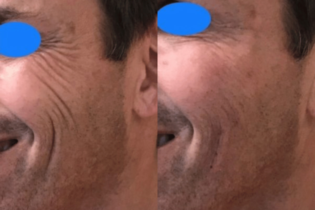 RHA Filler Male Crows Feet Before and After