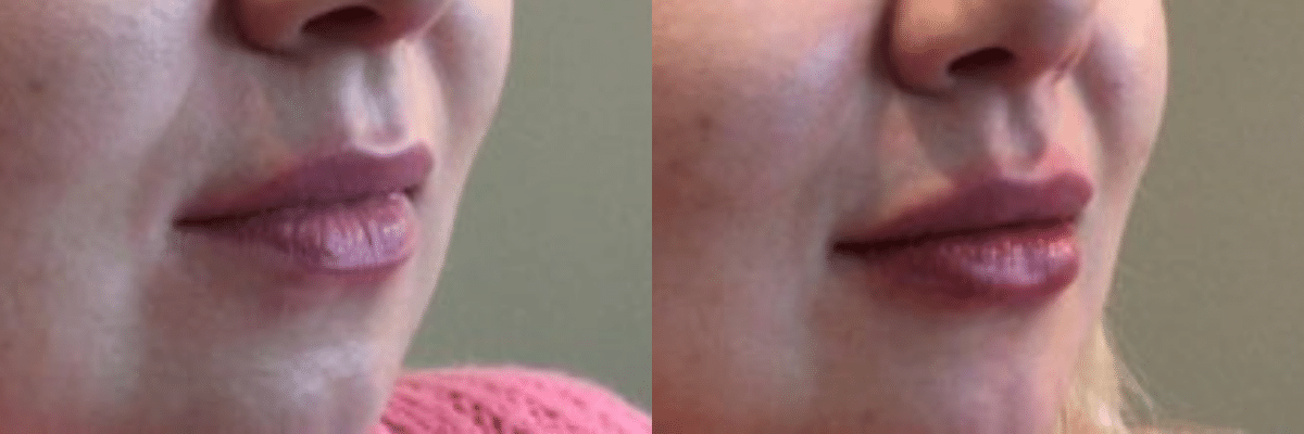 RHA Collection Lip Plump Before and After