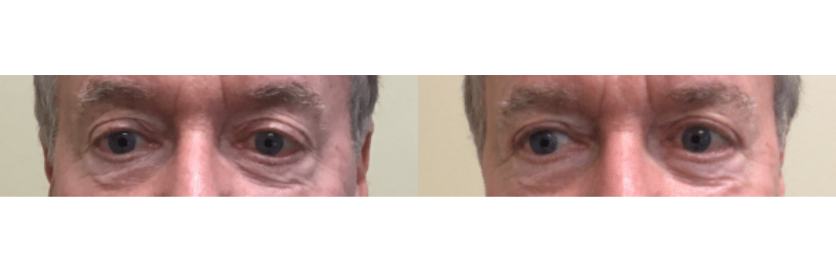 male before and after subnovii treatment to eyelids