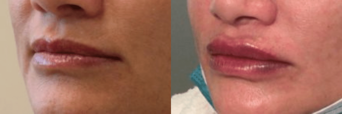 Juvederm Vollure lips side by side before and after