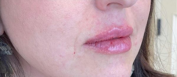 Lip Augmentation With Filler - After