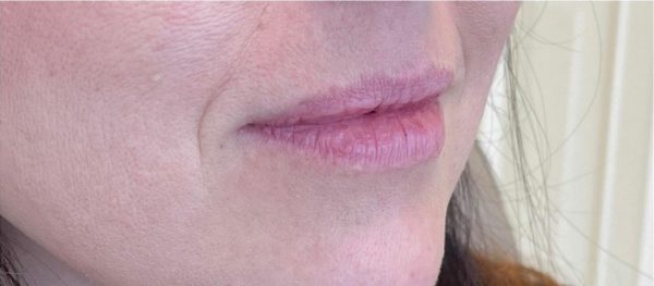 Lip Augmentation With Filler - Before