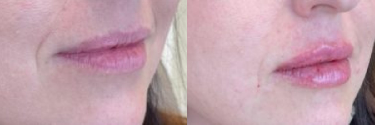 Before and after pictures of lip augmentation on female patient