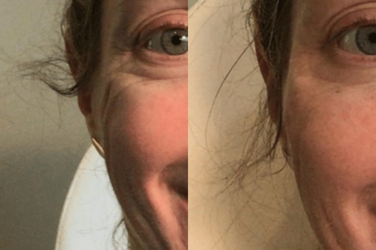 Crows Feet Correction With Juvederm Voluma Before and After