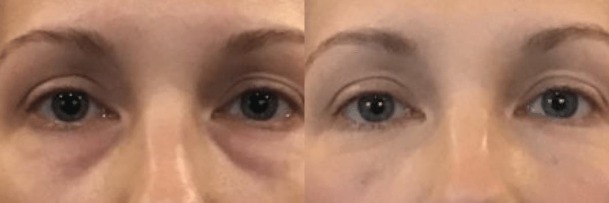 Juvederm treatment of dark circles before and after
