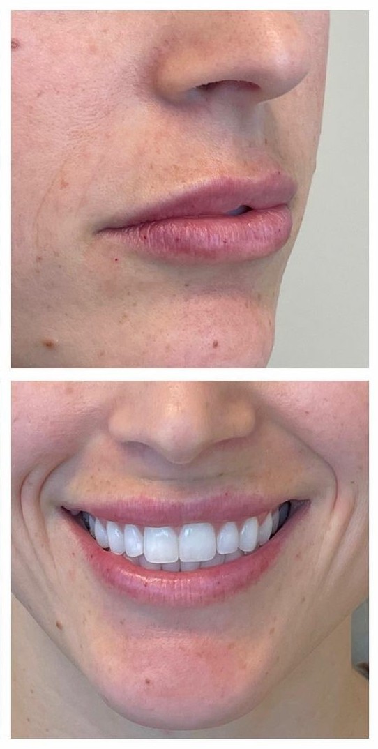 Juvederm Ultra Lip Augmentation After Photos