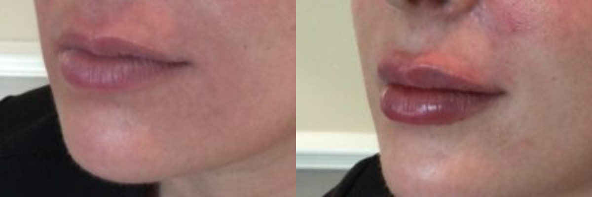before and after lip filler on female patient
