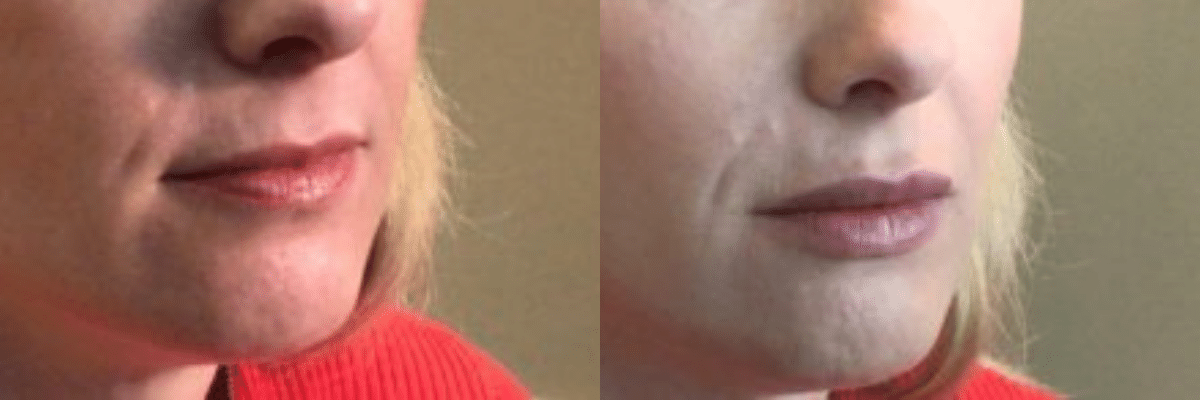 female patient before and after lip filler side view