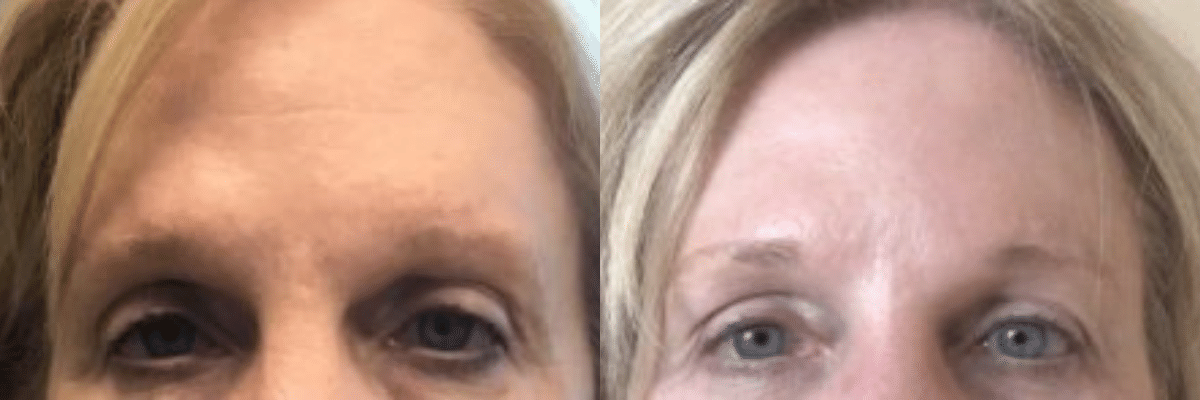 female patient botox forehead treatment before and after