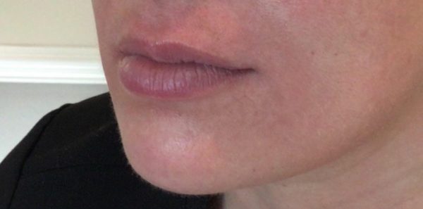Restylane Lip Filler Before Photo