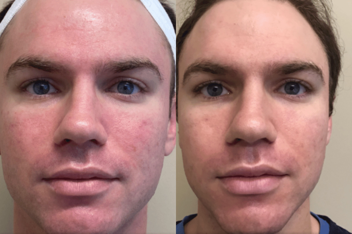 male before and after BBL treatment for redness front view