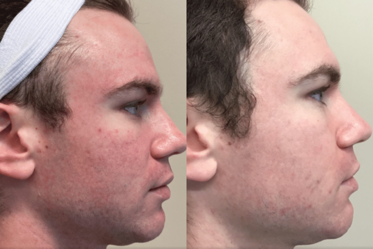 male before and after BBL treatment for redness side view