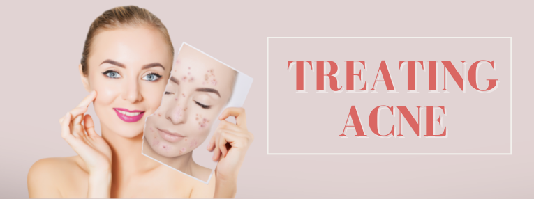 Acne Types, Causes, and Treatments for Adults and Teens