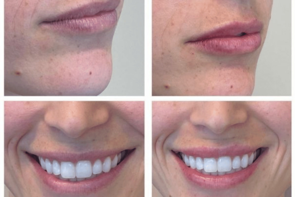 Juvdderm Ultra Lip Augmentation Before and After