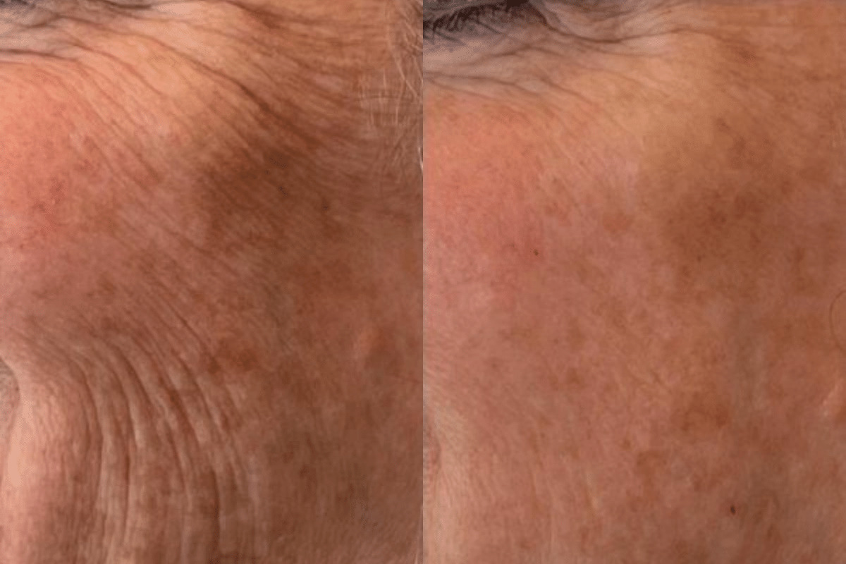 Patient 4093 RHA Collection Fillers in Cheek and Smile Lines Before and After