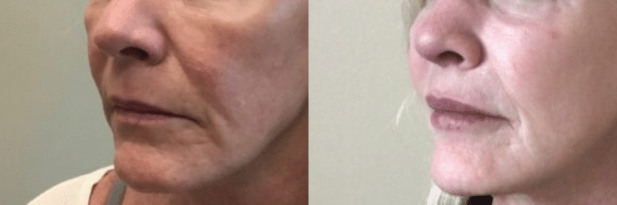 female lip filler side view before and after