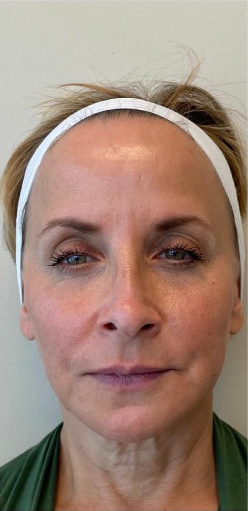Facial Rejuvenation Front View - After