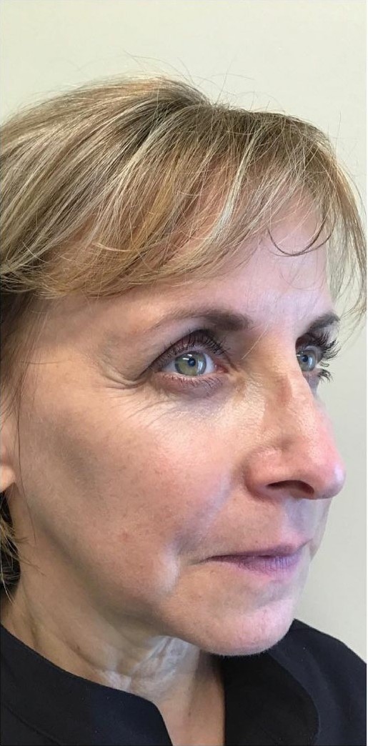 Facial Rejuvenation Side View - Before