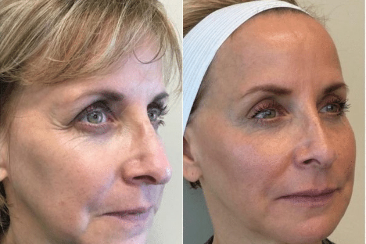 Facial Rejuventation Side View Before and After