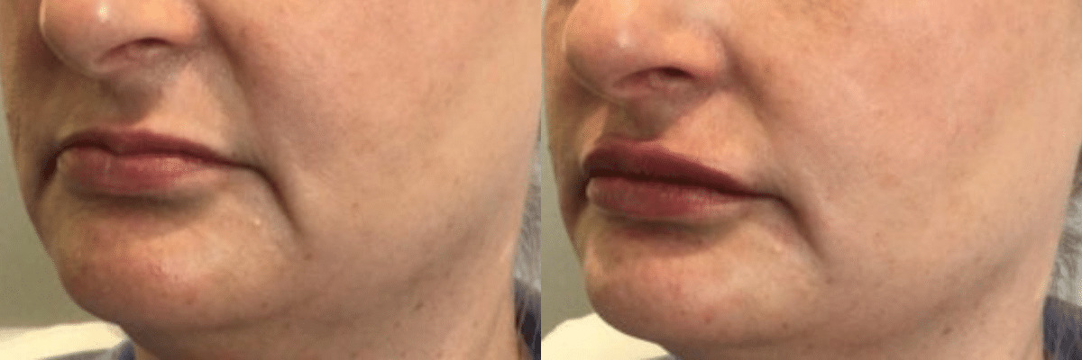 female patient lip filler before and after