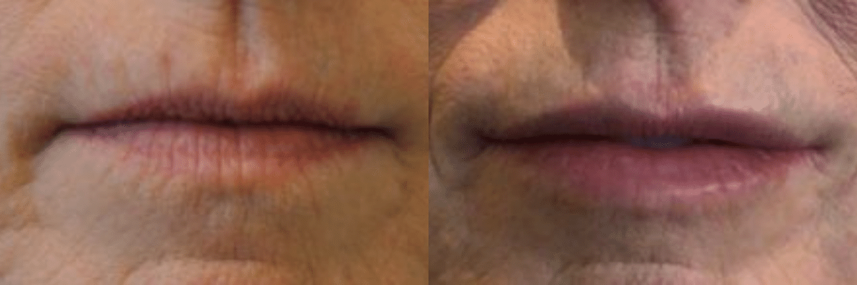 front view female patient RHA lip filler before and after
