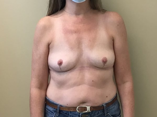 Breast Implant Removal - After Photo