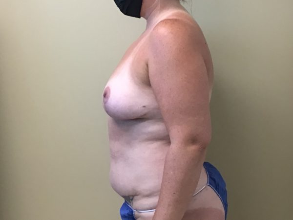 Breast Lift - Side After