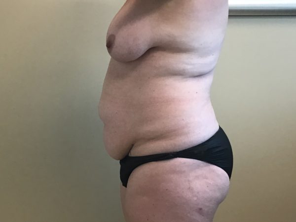 Breast Lift - Side Before