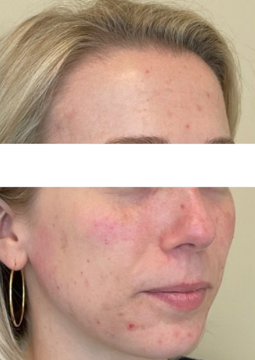Injectable Treatment for Tear Trough and Chin - After Photo
