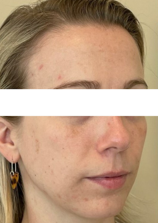 Injectable Treatment for Tear Trough and Chin - Before Photo