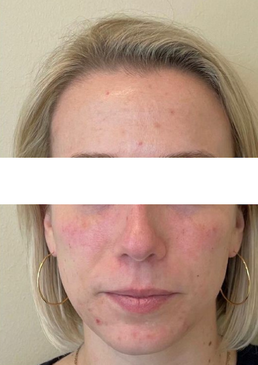 Injectable Treatment of Temple and Mid Face - After Photo