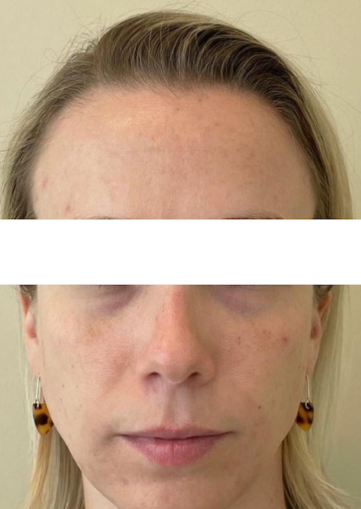 Injectable Treatment of Temple and Mid Face - Before Photo