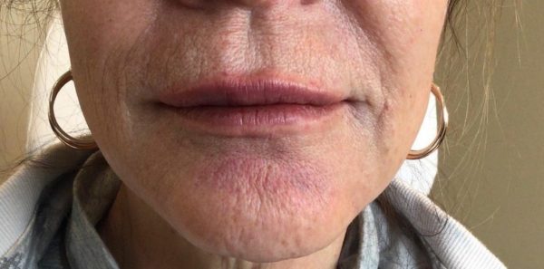 Juvederm Lip Filler After on Female Patient