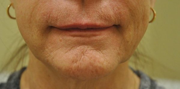 Juvederm Lip Filler Before on Female Patient