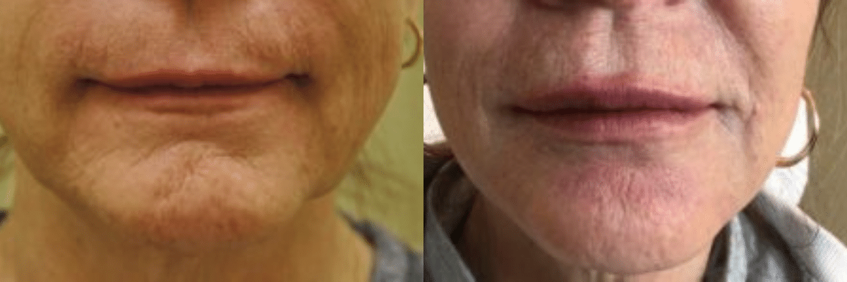 Juvederm lip filler before and after on a female patient