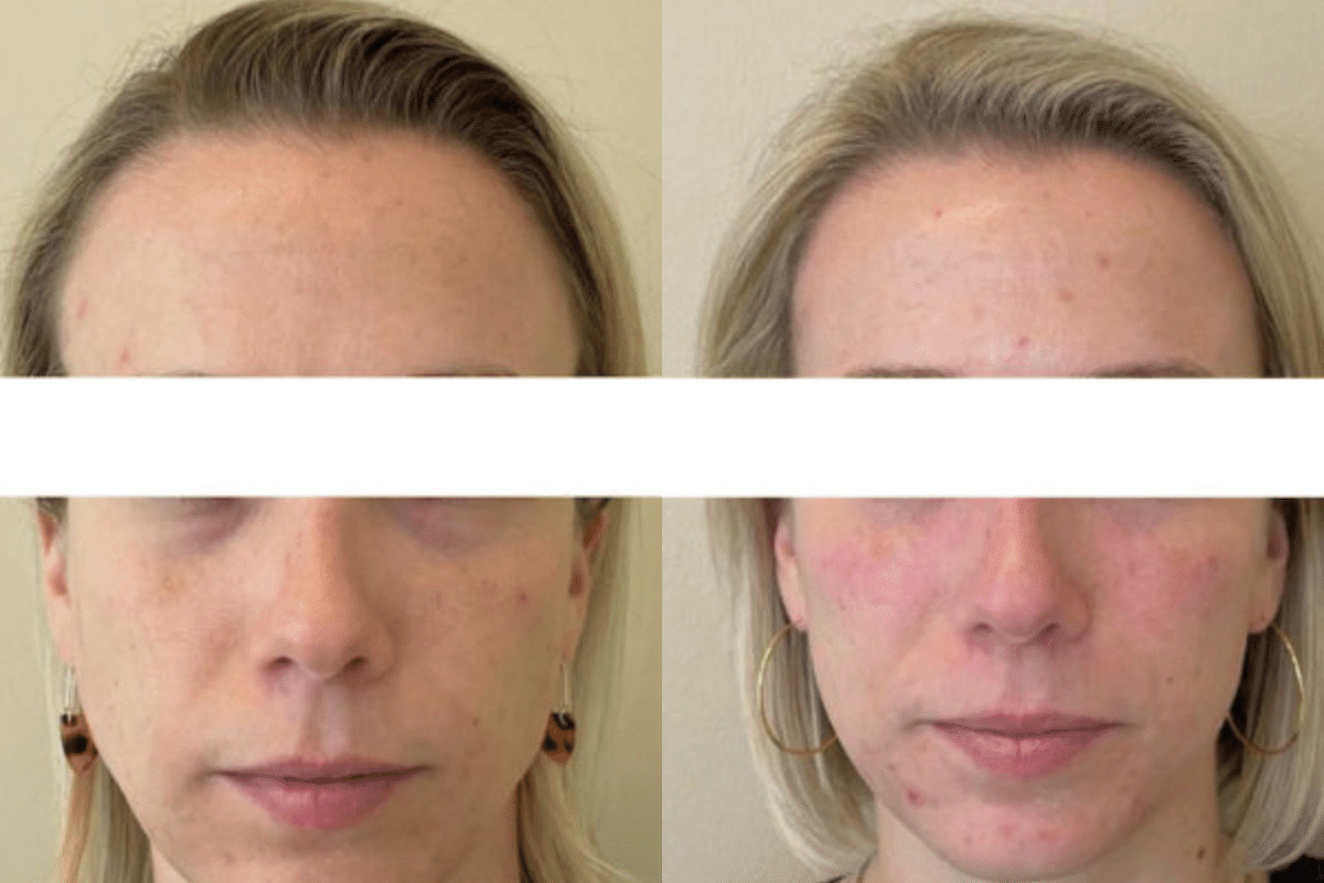 Injectable Treatment of Temple and Mid Face - Before and After Photo