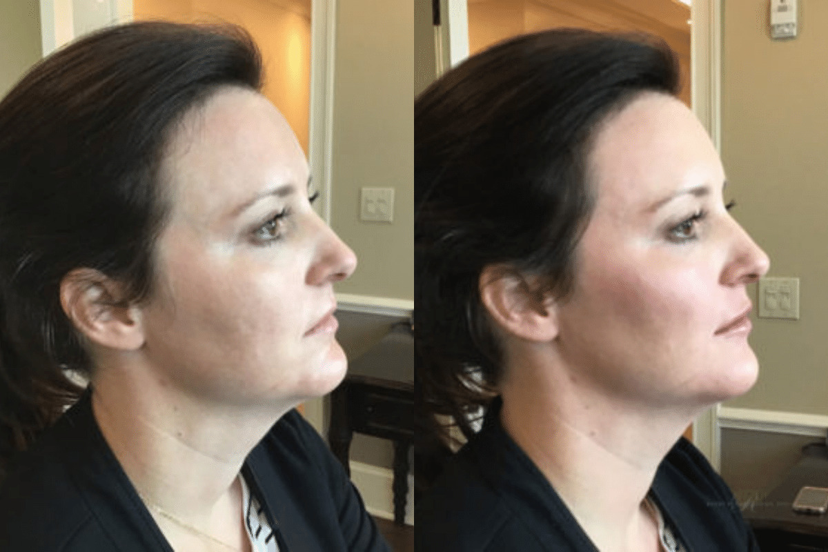 female injectable before and after photo
