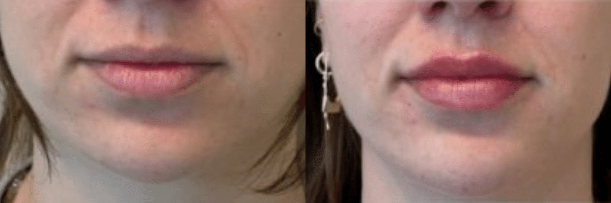 Before and After Photo - Juvederm Lip Augmentation Midtown Atlanta