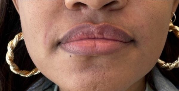 Lip Filler and Nasolabial Folds - After Photo