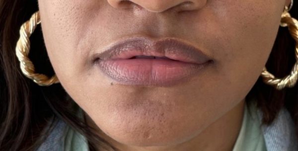 Lip Filler and Nasolabial Folds - Before Photo