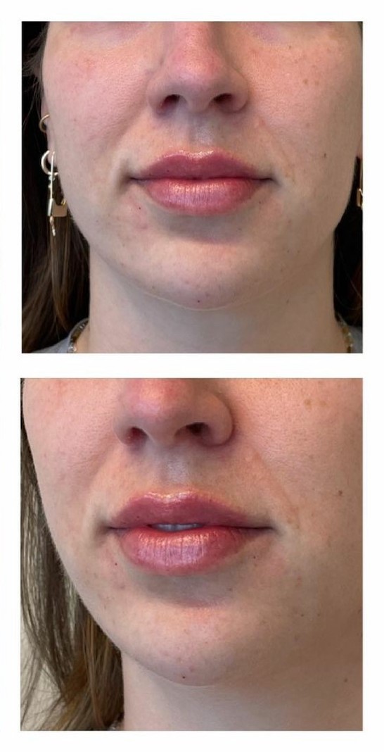 Lip and Chin Augmentation - After Photos