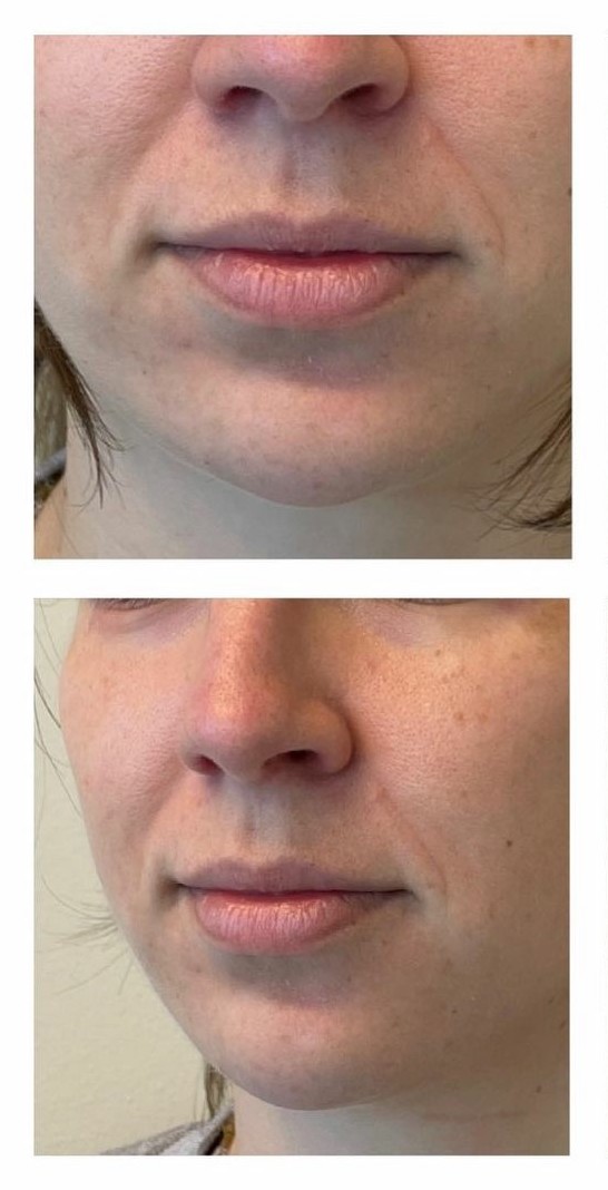 Lip and Chin Augmentation - Before Photos