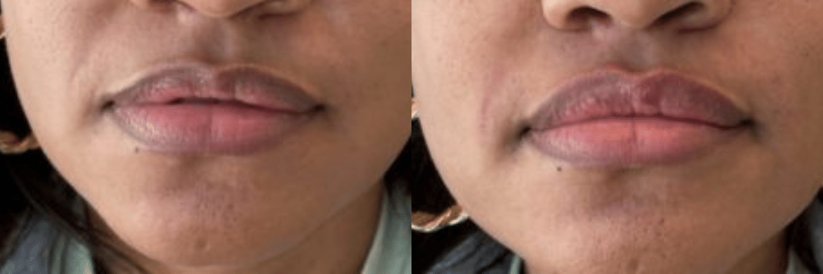 Lip Filler and Nasolabial Folds before and after