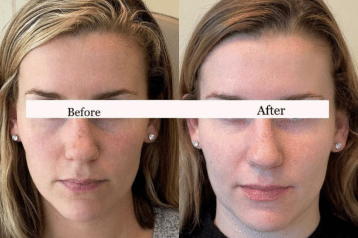 female patient before and after under eye treatment