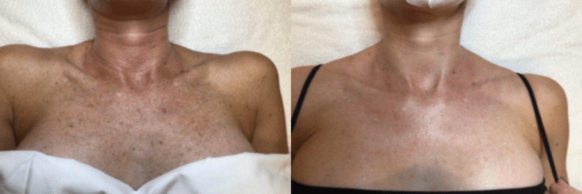 IPL Photofacial Before and After of the Chest