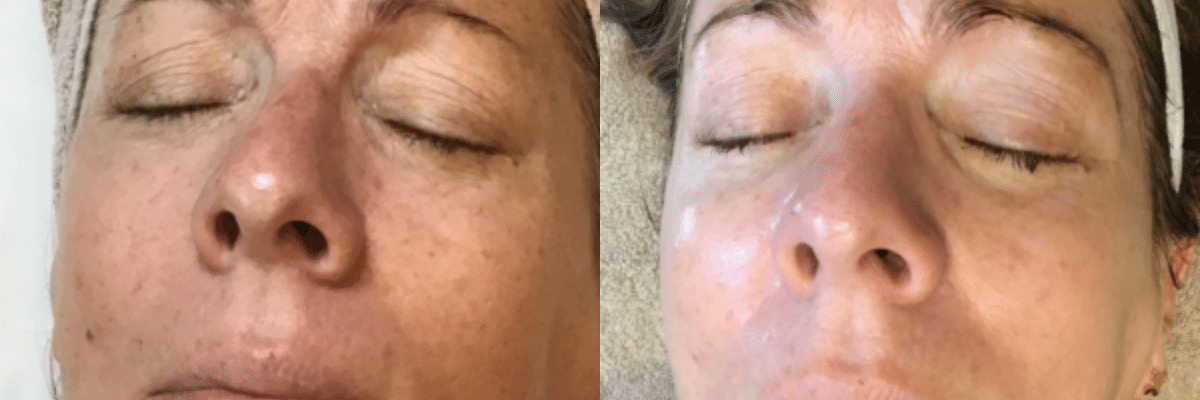 IPL Photofacial Treatment Before and After female patient