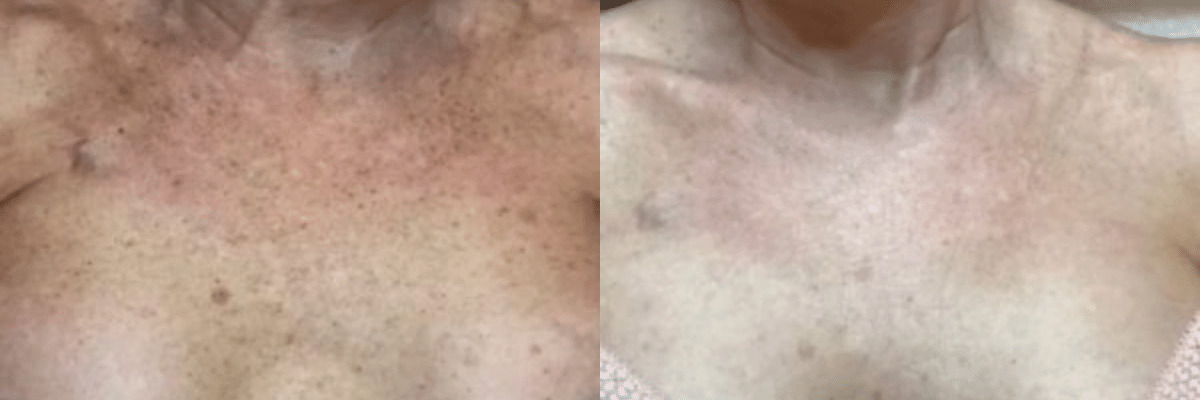 female chest before and after IPL photofacial treatment